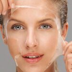 Chemical Peel